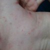 疥疮患者有哪些护理要点