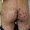 妇女疥疮的临床症状