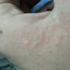 疥疮有哪些相对比较明显症状