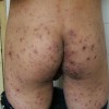 疥疮的继发症状有哪些