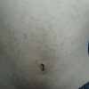疥疮的临床症状有什么