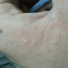 得了疥疮的临床症状有什么
