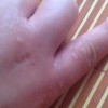 疥疮有哪些常见症状
