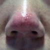 酒渣鼻的致病因素都有什么呢