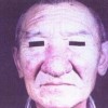 哪里可以治疗酒糟鼻