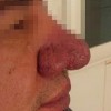 酒糟鼻的食物治疗的手法是什么