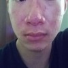 酒糟鼻应要如何治疗