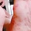 单纯性疱疹日常护理的措施