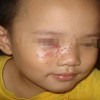 小儿单纯疱疹症状的基本表现