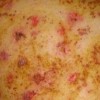 单纯疱疹病毒性角膜炎的发生介绍