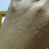 单纯疱疹感染儿童后的发展表