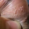尖锐湿疣患者应怎样护理病损部位