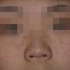 雀斑的护理办法