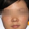 雀斑治疗时期的护理