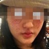 雀斑的检查措施