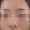 雀斑平时生活之中需要预防事项
