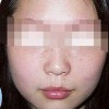 雀斑的预防办法有什么