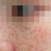 雀斑的治疗的手法对比介绍