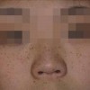 雀斑的治疗大概需要多少钱