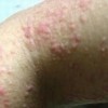 应对婴儿湿疹关键在护理
