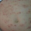 引起湿疹瘙痒的病因有什么