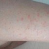 腿部湿疹出现的病因有什么