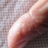 婴儿湿疹的主要症状是什么