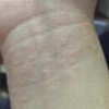 阴囊湿疹的症状有哪些