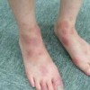 面部湿疹的症状表现有哪些