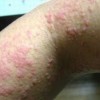 怎样辨别阴囊湿疹的症状