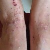 面部湿疹的症状及应注意一些事项是什么