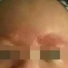 西医如何治疗湿疹