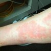 治疗手部湿疹的关键