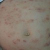 治疗慢性湿疹的三点有效措施