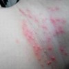 婴儿湿疹用什么药治疗好
