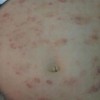 治疗湿疹费用多少