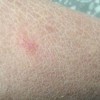 专家教你怎样的预防鱼鳞病加剧病况