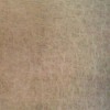 鱼鳞病症状具体表现