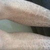 鱼鳞病症状体现