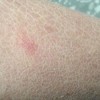 鱼鳞病治疗贵吗