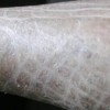 鱼鳞病治疗医院