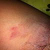 尖锐湿疣怎样护理