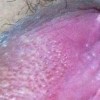 尖锐湿疣小丘疹的临床症状
