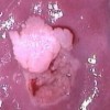 尖锐湿疣药物治疗原则