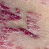 关节型牛皮癣如何分类