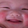 固执性牛皮癣