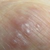 治疗疥疮应该有哪些要注意问题