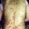 脸上疥疮怎么治