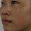 喝粥治疗黄褐斑