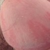 龟头炎应该要如何护理